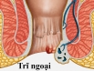Liệu bệnh trĩ ngoại độ 1 có tự khỏi được không?